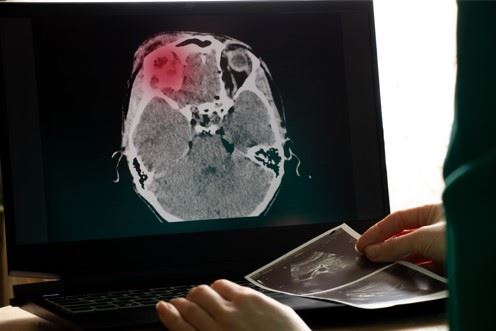 doctor looking at computer images of a brain injury